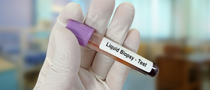 Liquid Biopsy –  A New Ally for Lung Cancer Treatment